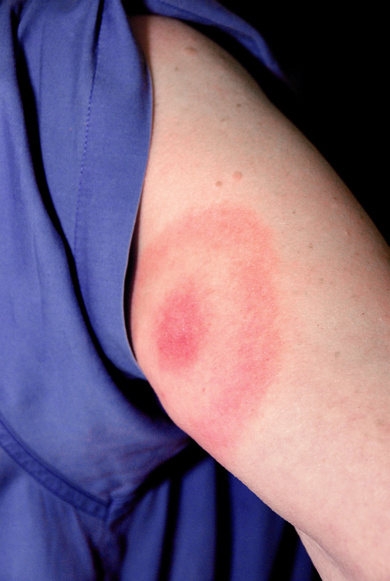 erythema migrans, red bullseye rash on someone's arm