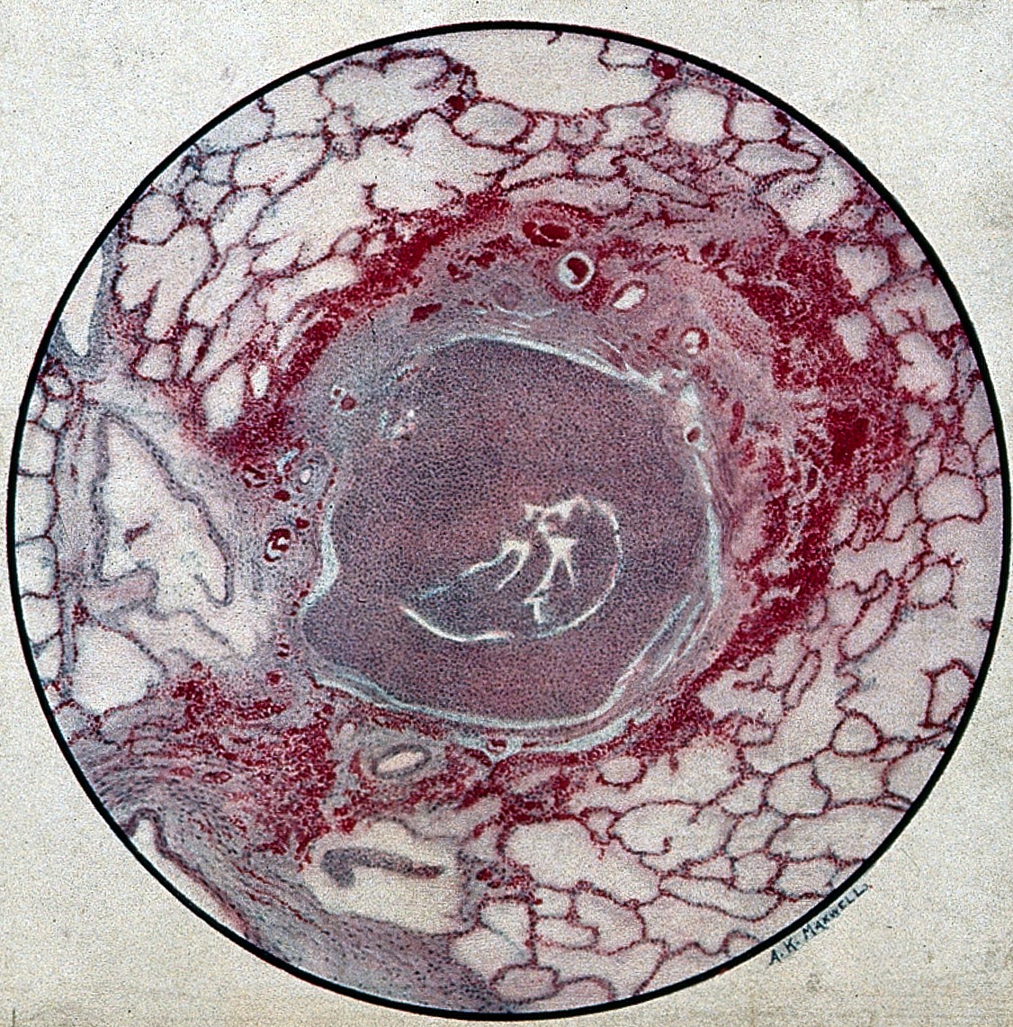An image showing a cross section of lung being damaged by mustard gas. The image is of a circle with a webbing of red lines making up the ling tissues. At the center is a large grey blob that extends through the tissue to the lower right hand corner. 
