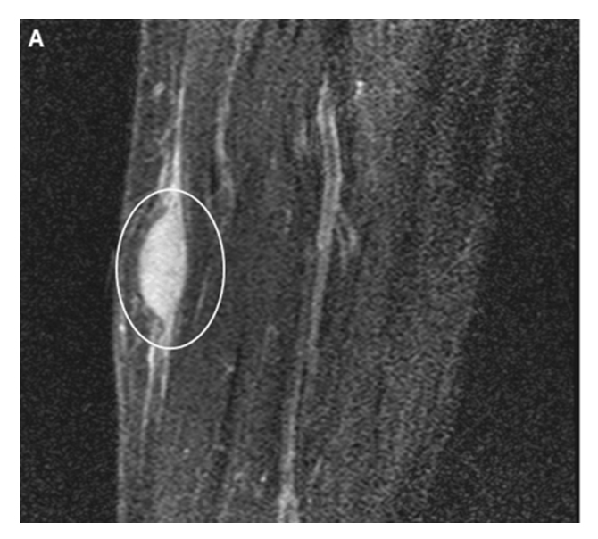 An MRI scan of the tumor in the surrounding flesh. It appears as an oval shape close to the surface of the skin. 