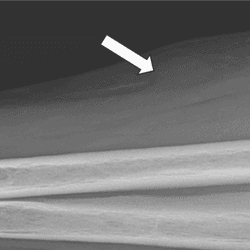 An x-ray image showing the right forearm. The patient's radius and ulna are clearly visible and so is the wrist, which is positioned at the far left of the image. Around half way along the forearm is a white arrow indicating where the tumor is.